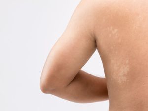郑州哪家白癜风医院口碑好，缺铜导致白斑如何通过饮食补充铜元素