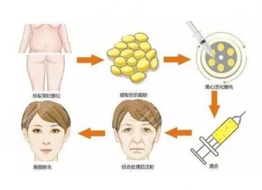 脂肪填充全脸的方法是怎么做的?
