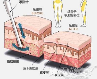 巴中依韩吸脂手术原理