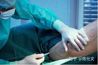 吸脂手术后能管几年_吸脂手术后能管几年能吸小腿吗_吸脂手术可以做吗