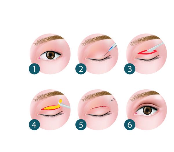 上眼皮抽脂幾天消腫