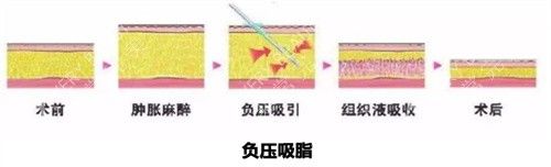 抽脂手術(shù)方式動畫圖
