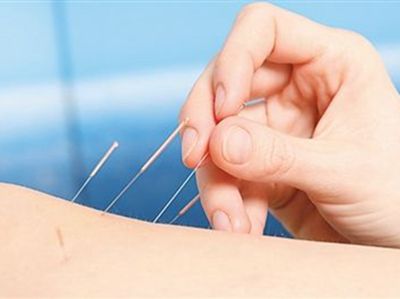 女性针灸减肥都扎哪几个穴位