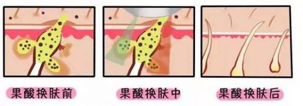 果酸换肤.jpg