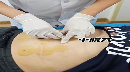 【名术天工集】济南市中西医结合医院穴位埋线减肥疗法：绿色瘦身 让美丽不设限