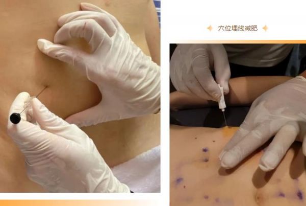 【智象医疗】穴位埋线减肥——一次减肥，终身“瘦”益