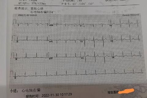 心电图电轴右偏解析_临床意义与诊断要点探讨
