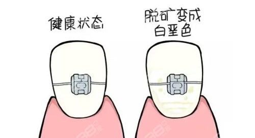 牙齿脱矿是什么意思？