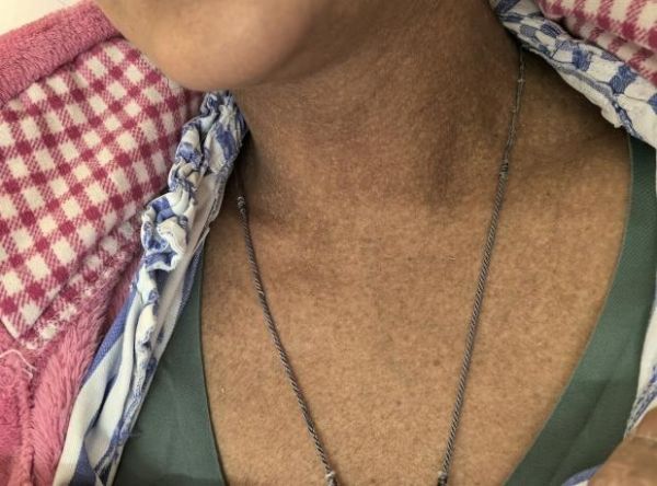 35岁女子突患怪病，一查竟是“砒霜”中毒！