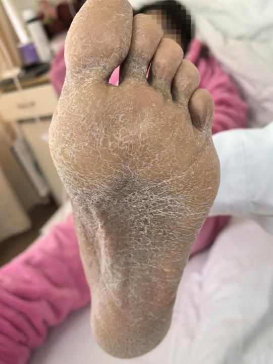 35岁女子突患怪病，一查竟是“砒霜”中毒！