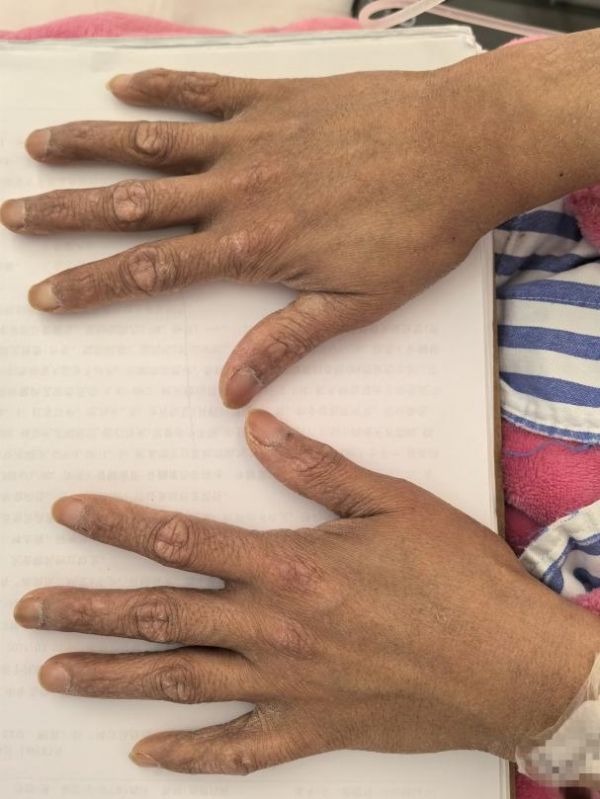 35岁女子突患怪病，一查竟是“砒霜”中毒！