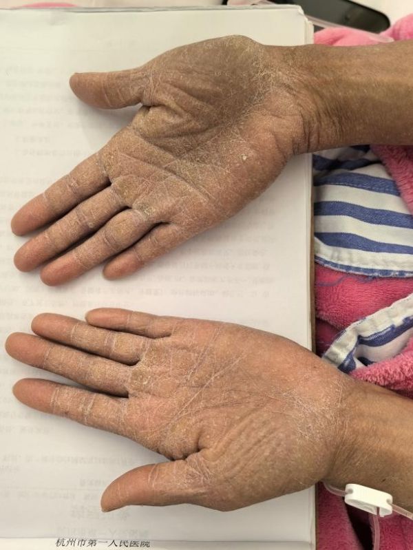 35岁女子突患怪病，一查竟是“砒霜”中毒！