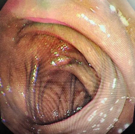 35岁女子突患怪病，一查竟是“砒霜”中毒！