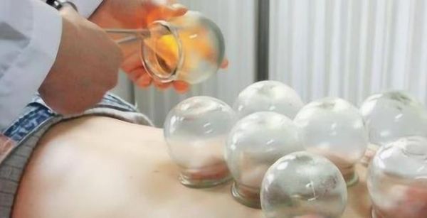 拔火罐后滿背紫印，真能排毒？真相讓人意外