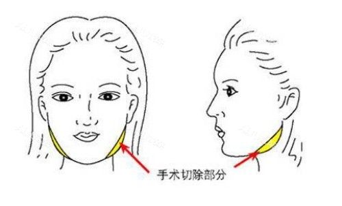 面部磨骨手術(shù)示意圖