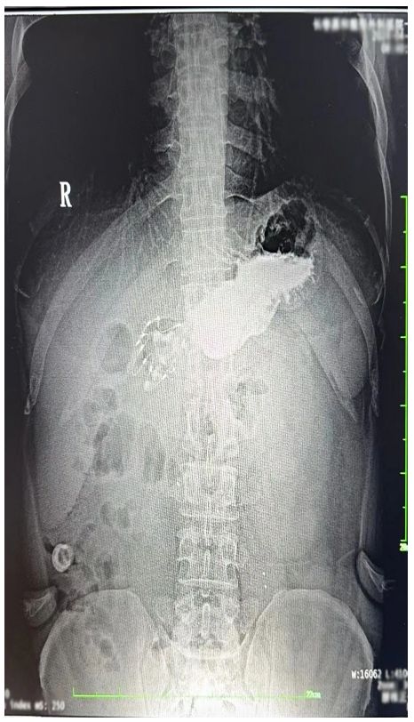上消化道造影照片