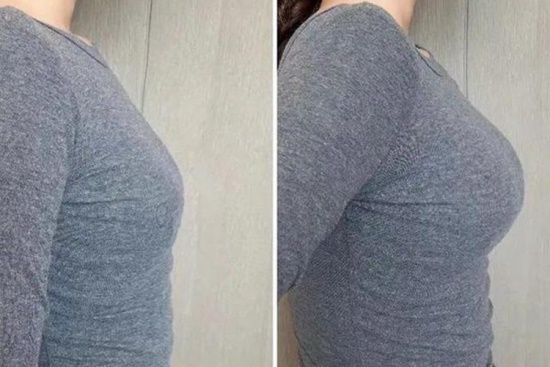 妊娠期乳房增大圖
