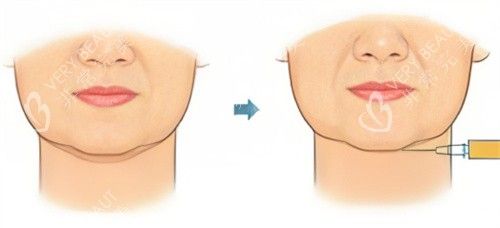 双下巴注射示图