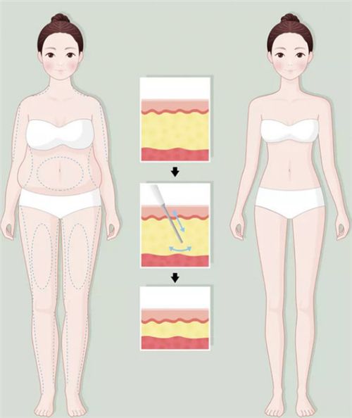 吸脂前后动画图示