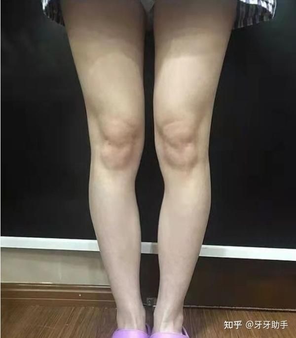 吸脂減肥醫(yī)院哪家好_減肥醫(yī)院吸脂好嗎_減肥醫(yī)院吸脂好不好