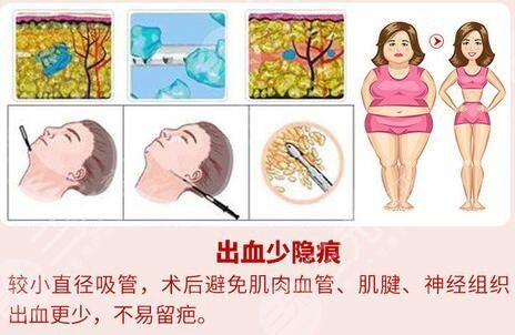 吸脂手術(shù)