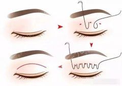 镇江双眼皮手术哪家医院好？3大公立整形科实力测评！附价格