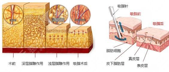 杭州面部吸脂多少钱