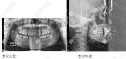 因露齦笑，出現(xiàn)骨性齙牙癥狀正畸前圖片