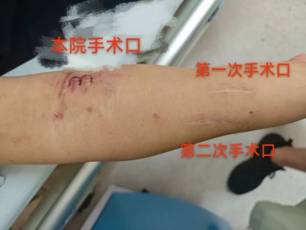韓國(guó)患者血管通路遇難題，深圳專(zhuān)家緊急手術(shù)解危機(jī)