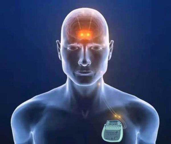 脑深部电刺激手术（DBS）到底是选STN？还是GPi？