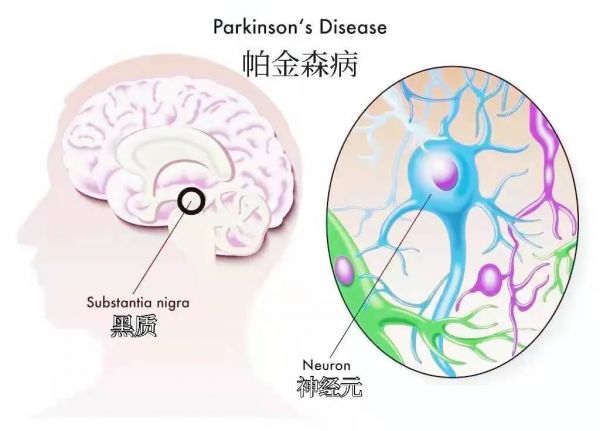 脑深部电刺激手术（DBS）到底是选STN？还是GPi？