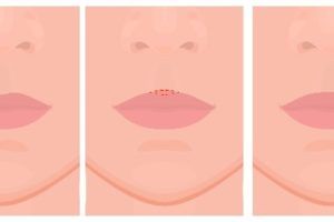 Cupid’s Bow, the double curve in the middle of the upper lip changes with aging