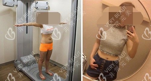 韩国365mc抽脂前后对比示意图