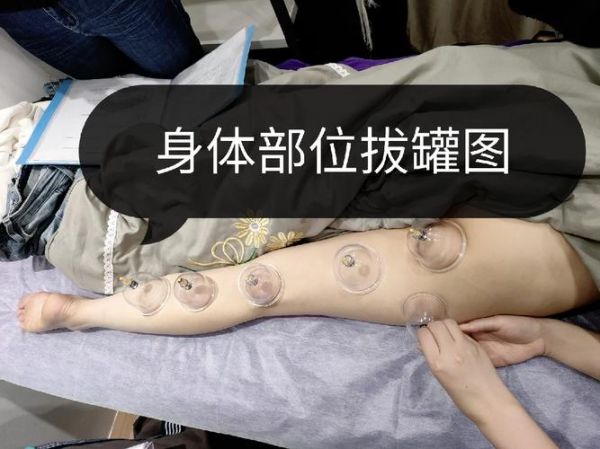 上海哪里有拔火罐減肥