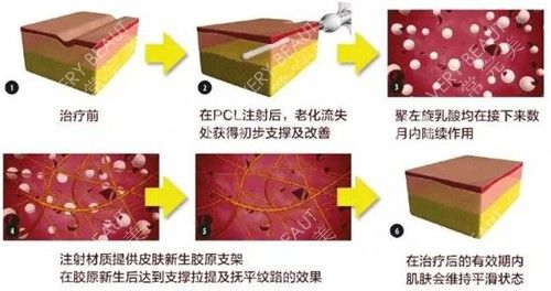 童颜针注射前后变化图解