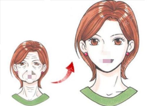 拉皮手术前后对比图
