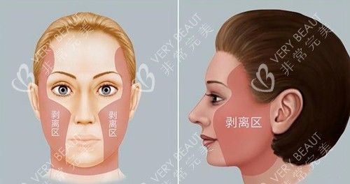 拉皮手术剥离区