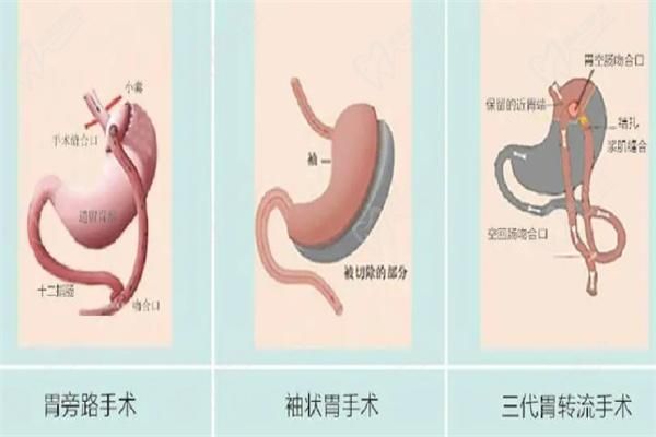 不同切胃减肥手术