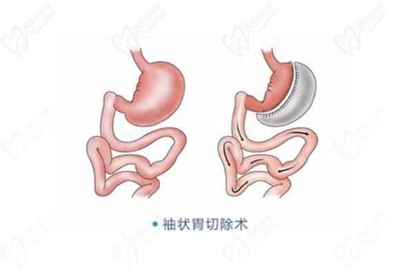 切胃减肥手术保报销吗