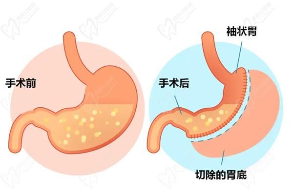 不同切胃手术价格不同