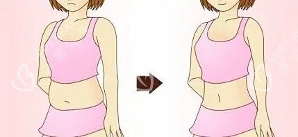 腰腹吸脂对比卡通图
