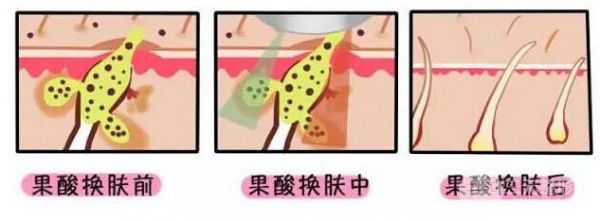 果酸换肤的作用原理