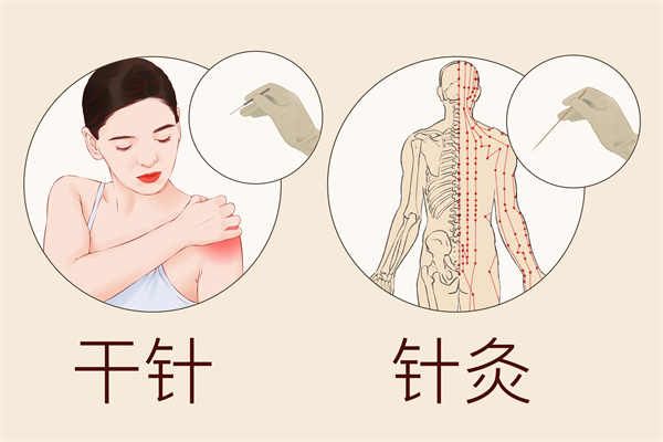 中醫(yī)解答針灸減肥三大疑惑
