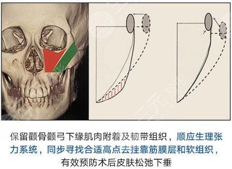 田凱月醫(yī)生科普顴骨整形手術(shù)