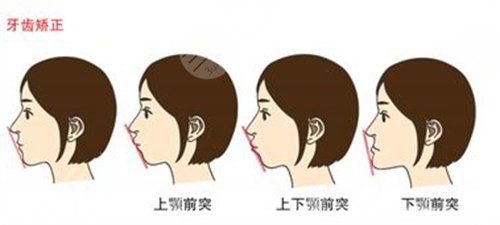 侯振杰正頜手術(shù)后7周
