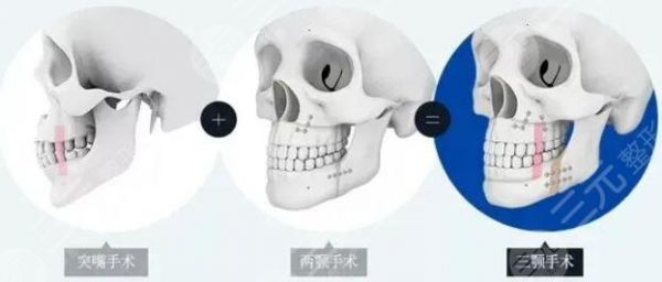 侯振杰正頜手術(shù)
