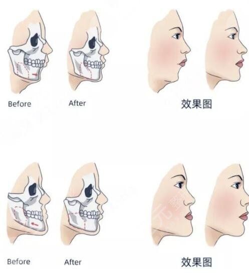 多大年紀(jì)適合做正頜手術(shù)