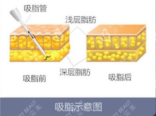 吸脂前后示意图