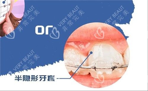 半隐形牙套示意图