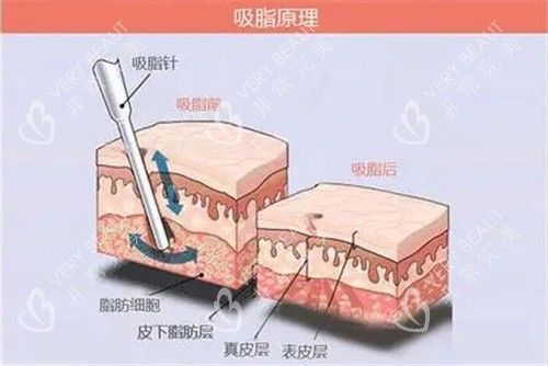 吸脂原理展示